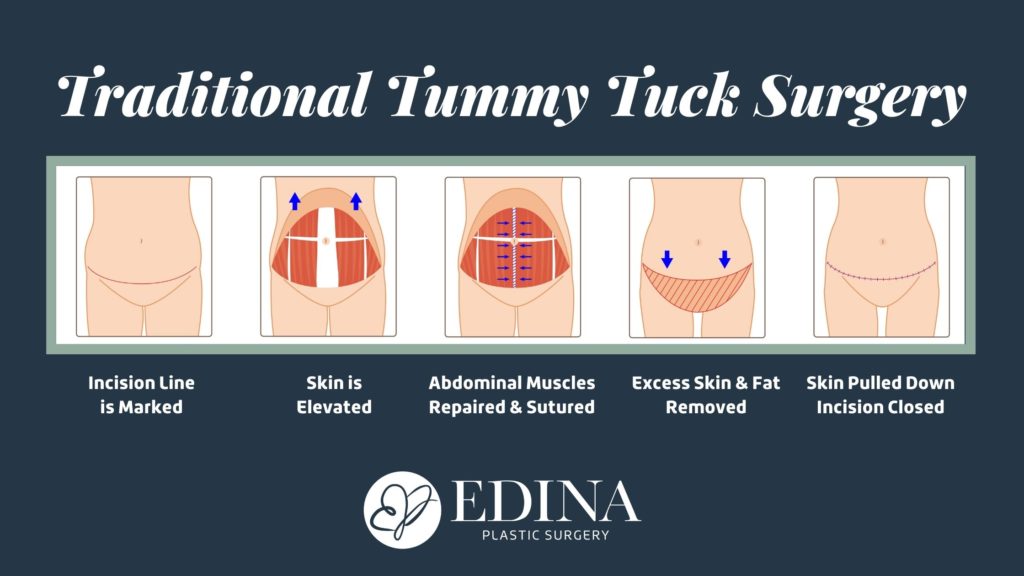 5 Ways to Fade & Treat Your Tummy Tuck Scar