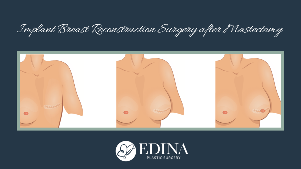 Breast-Reconstruction-Surgery