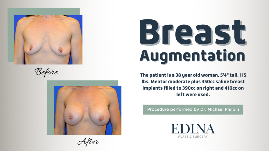 Breast Augmentation 