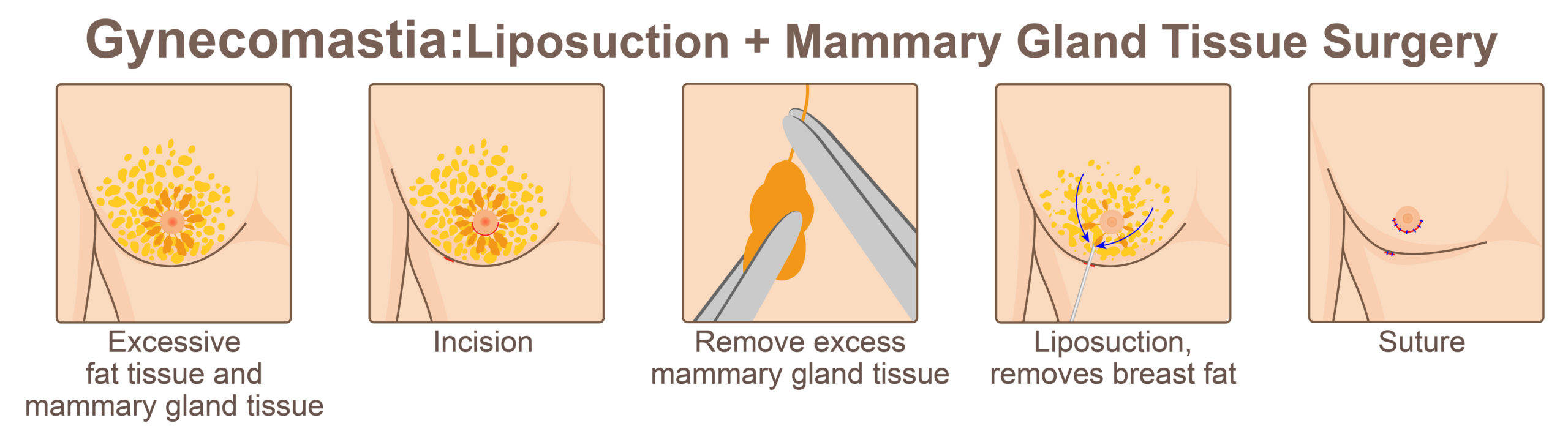 Gynecomastia Process
