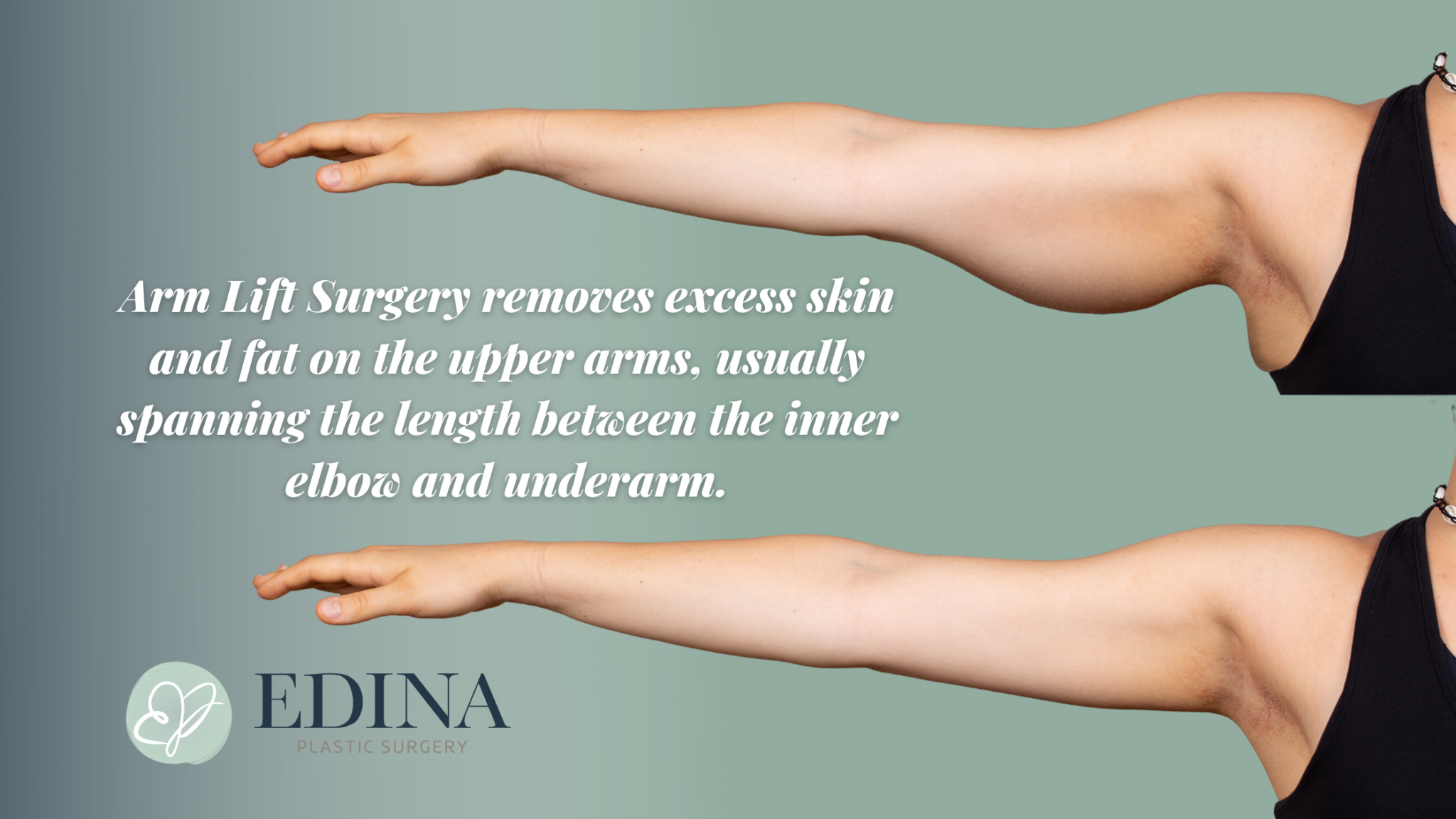 Arm Lift Surgery Your Timeline to Recovery & Top Tips for Healing