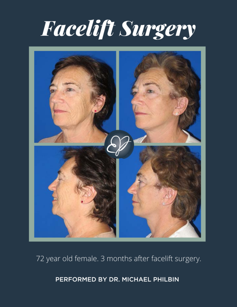 What is the Best Age for Facelift Surgery?