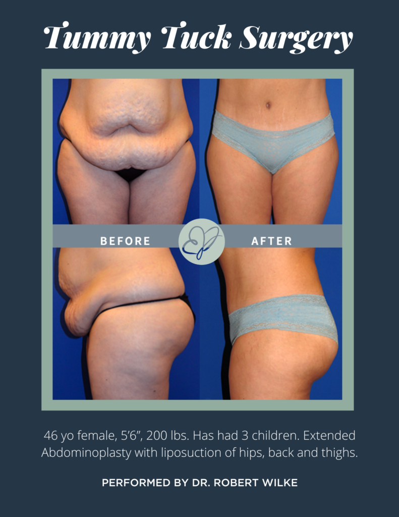 tummy tuck before and after