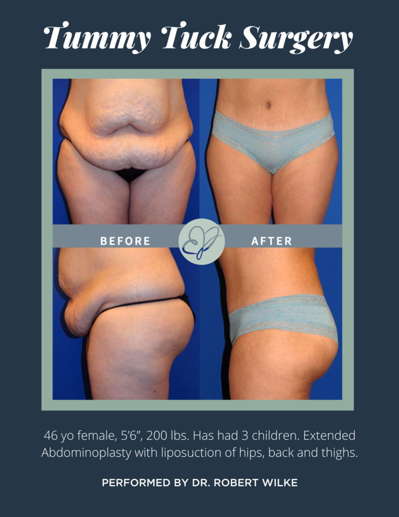 Best Tummy Tuck Before and After -100% Safe & Secure Surgery