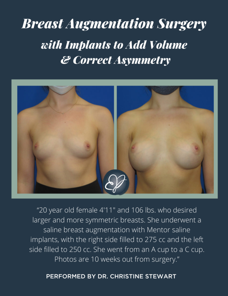 breast asymmetry before and after