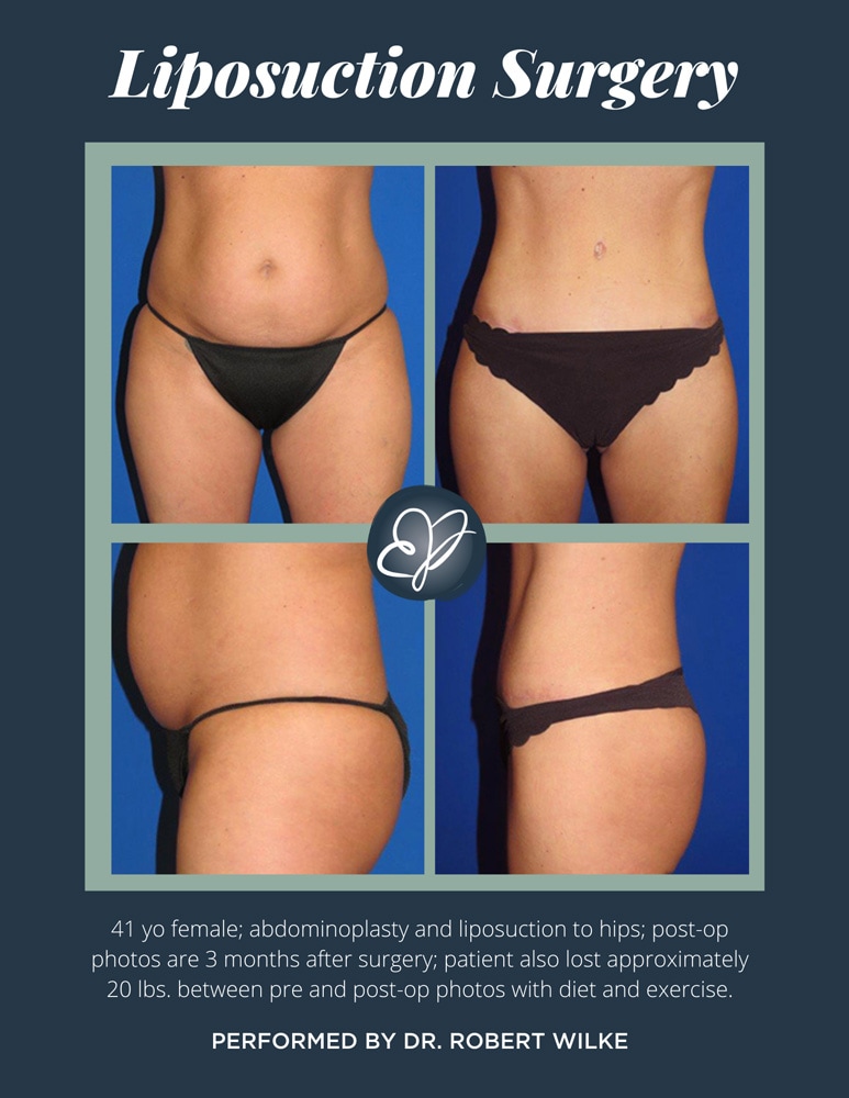 What is Liposuction? Is There Any Risk in Liposuction Surgery?