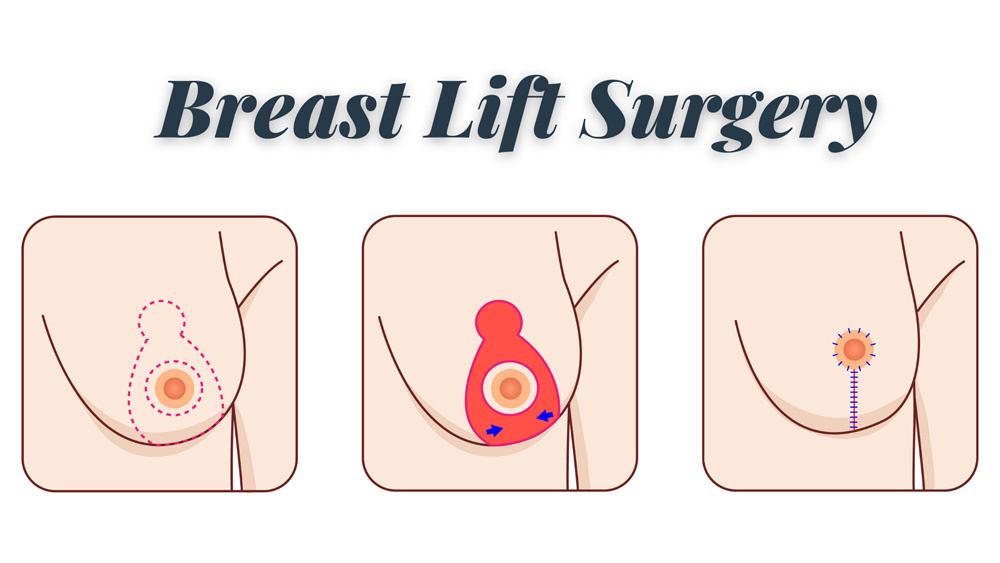 What Will My Scars Look Like After Breast Lift Surgery?