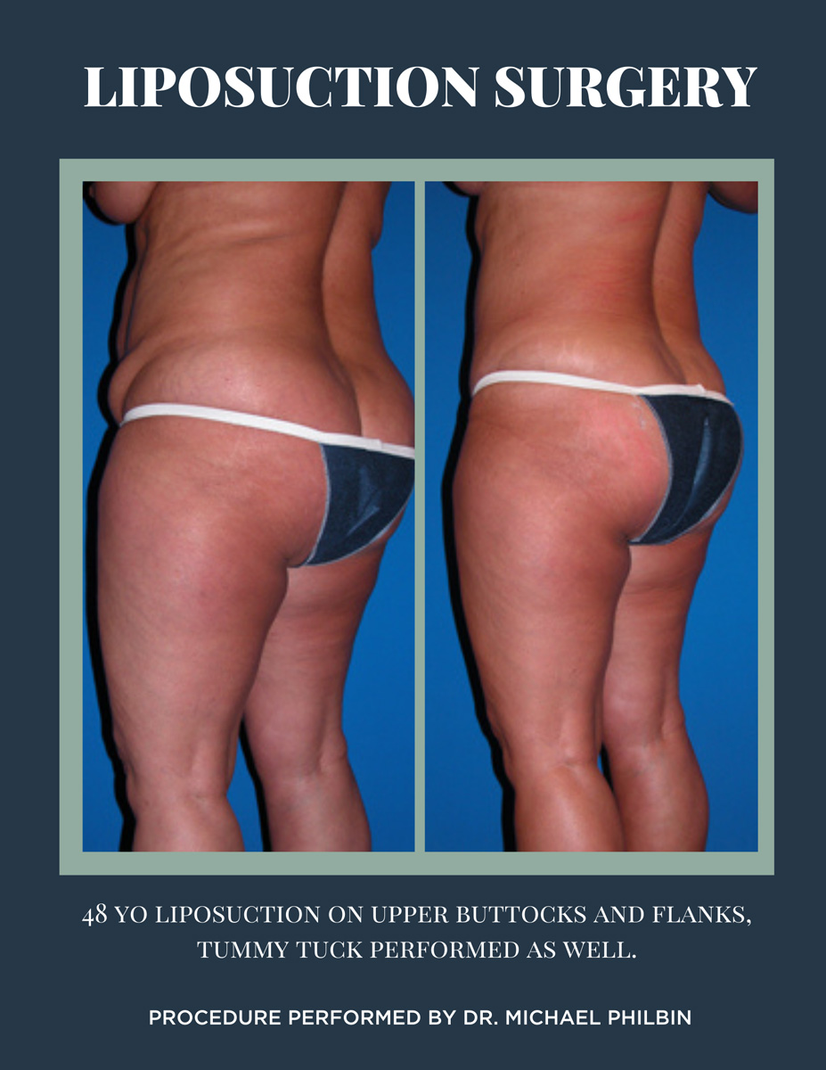 Bra Roll Liposuction before after