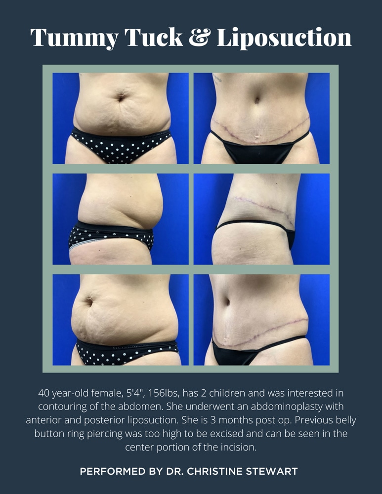 Tummy tuck  Abdominoplasty surgery and mini tummy tuck