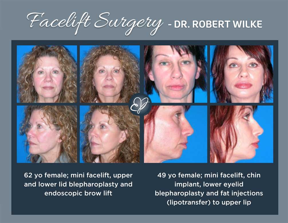 What s The Difference Between A Mini Facelift Full Facelift Edina what-s-the-difference-between-a-mini-facelift-full-facelift-edina