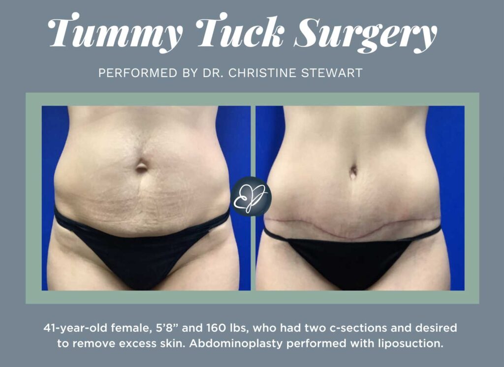 Will Tummy Tuck Surgery Change the Appearance of My Belly Button