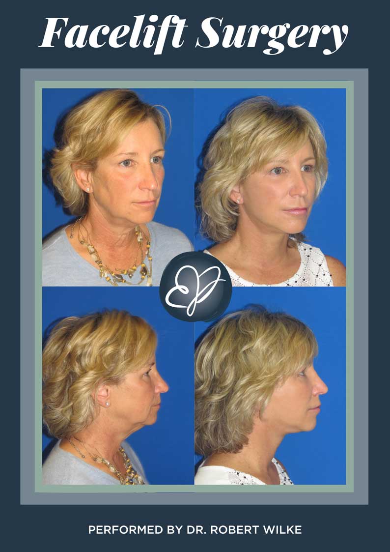 faceliftsurgerybawilke Edina Plastic Surgery