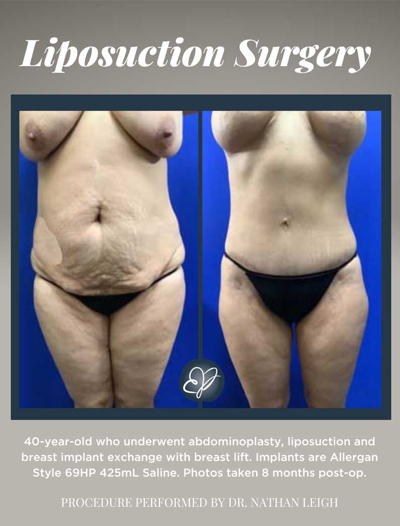 How to Maintain Abdominoplasty Results?