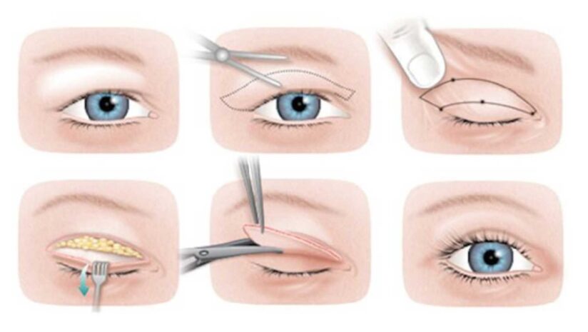 upper-bleph-treatment | Edina Plastic Surgery