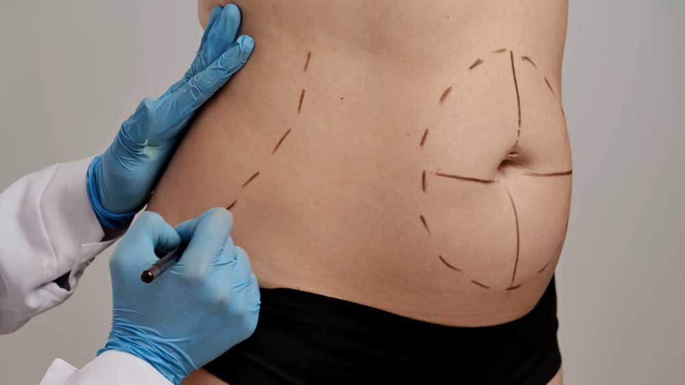 patient at a liposuction consultation